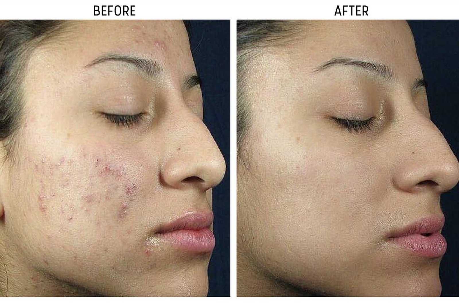 Before and after acne and skin clarity progress at The Skin Method Tweed Heads