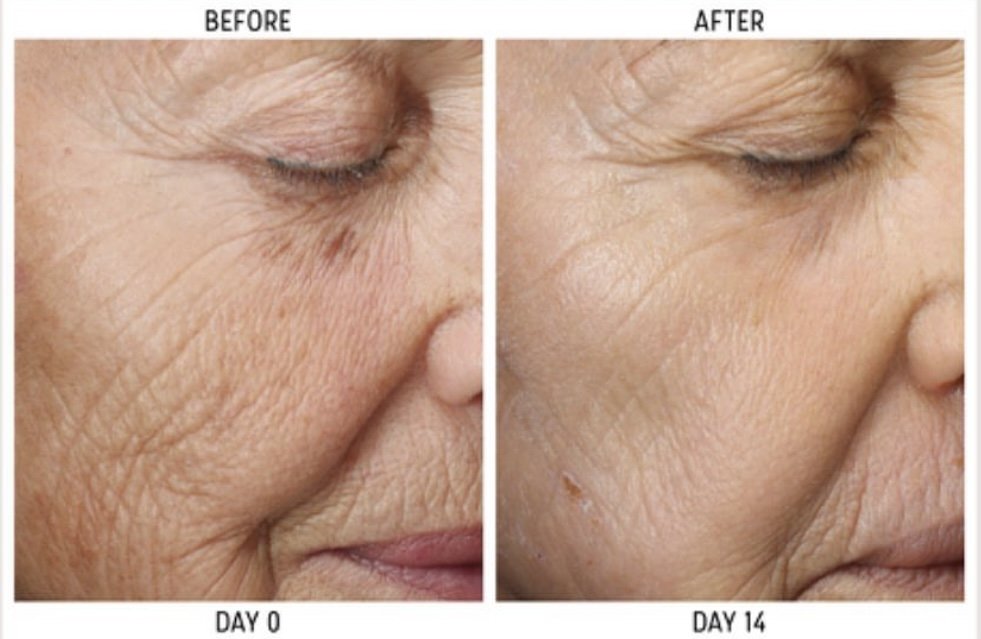 Before and after fine line softening progress at The Skin Method Tweed Heads