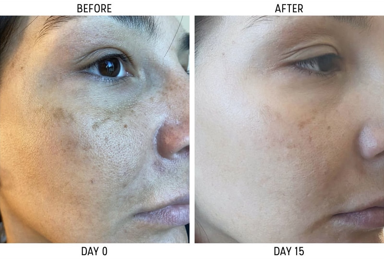 Before and after pigmentation improvement from day 0 to day 15 at The Skin Method