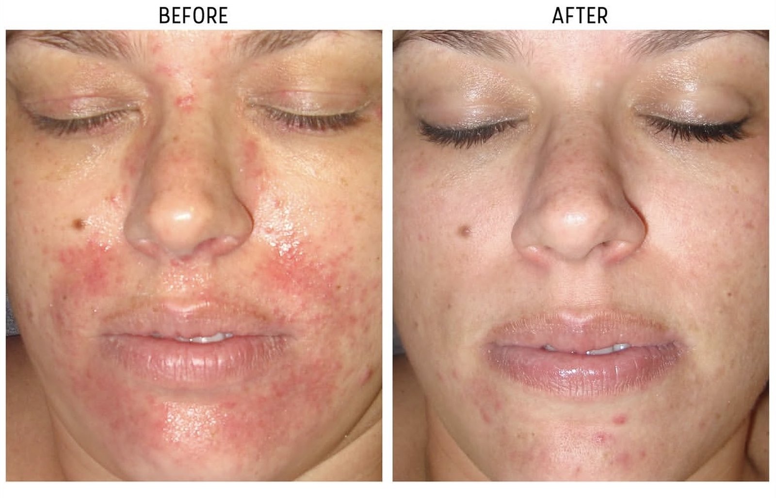 Before and after redness calming progress at The Skin Method Tweed Heads