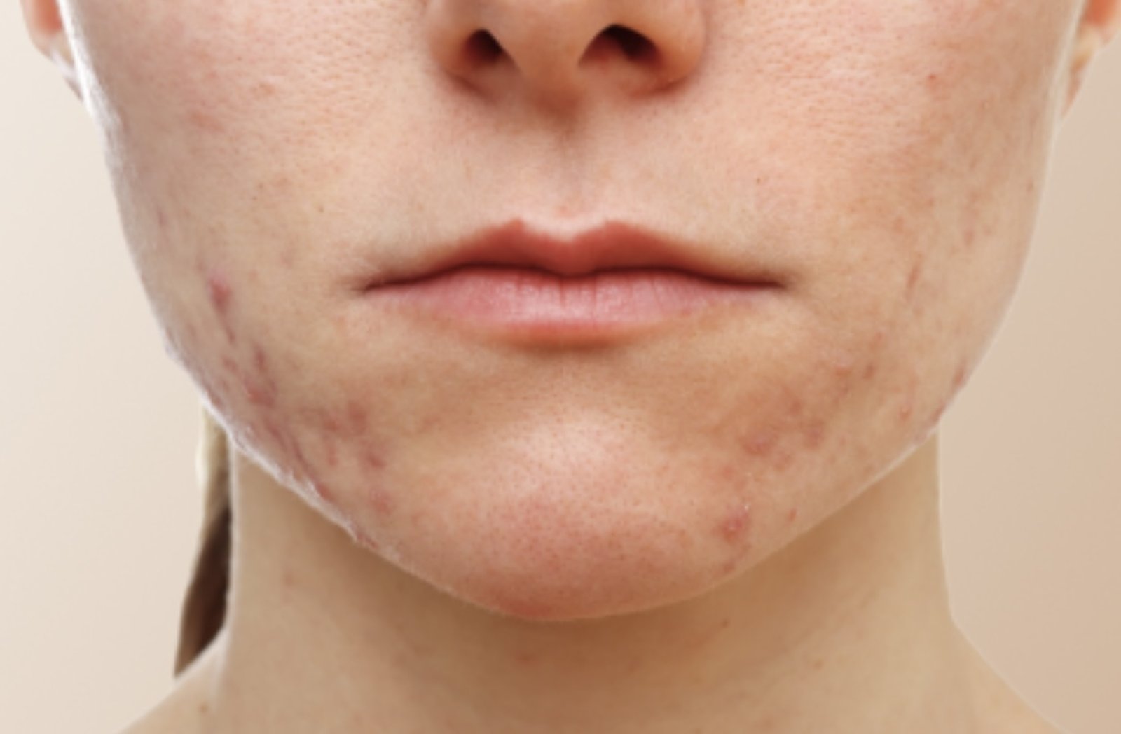 Acne and congestion concern around the lower face