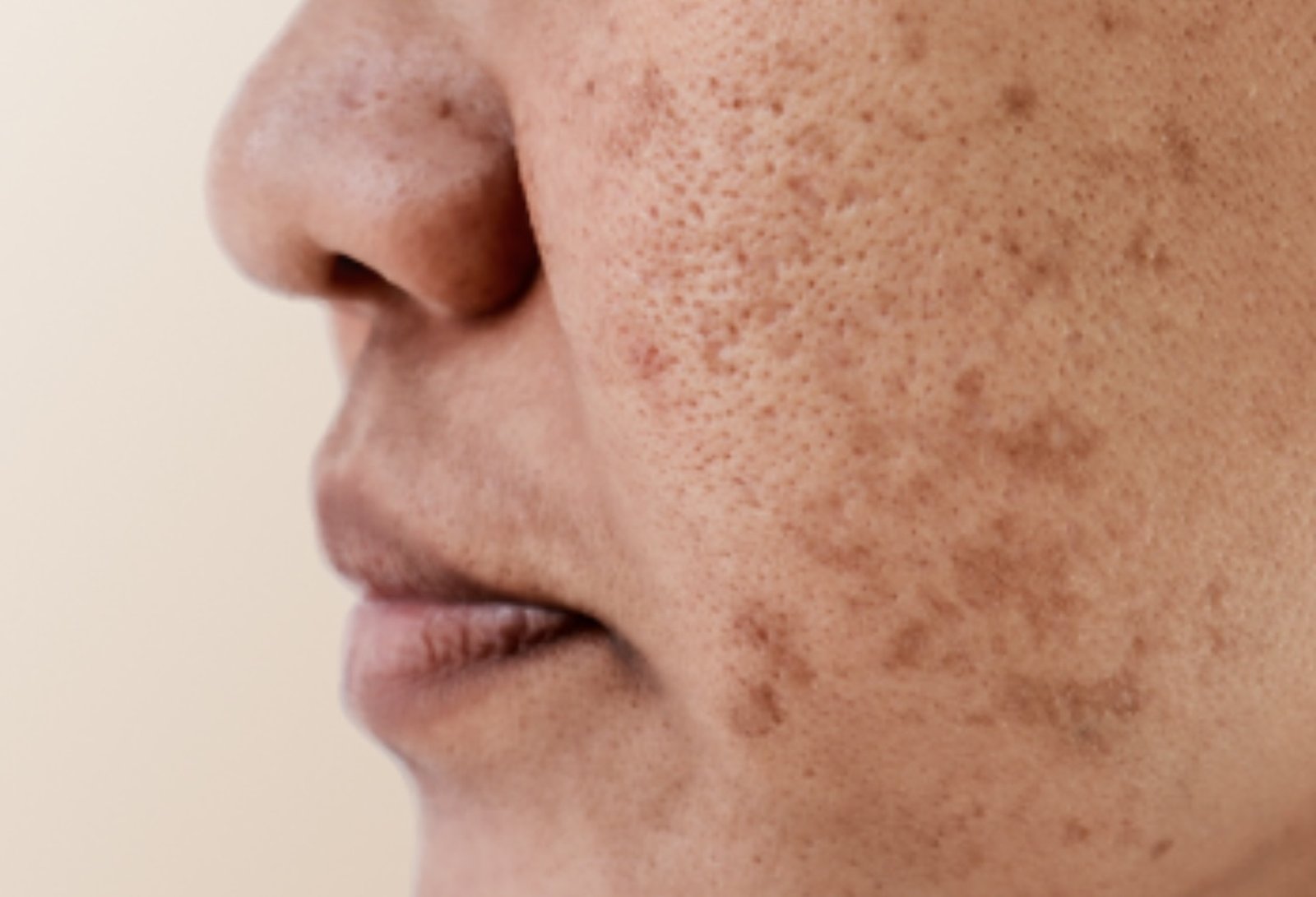 Pigmentation and melasma concern close-up